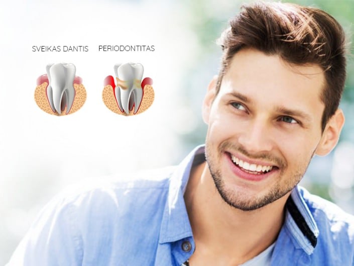 Periodontitas burnos higiena 40 eur