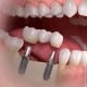 implantas keli dantys